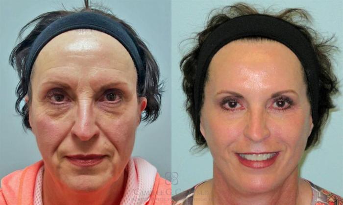 Before & After Facelift Case 163 View #1 View in Houston, TX