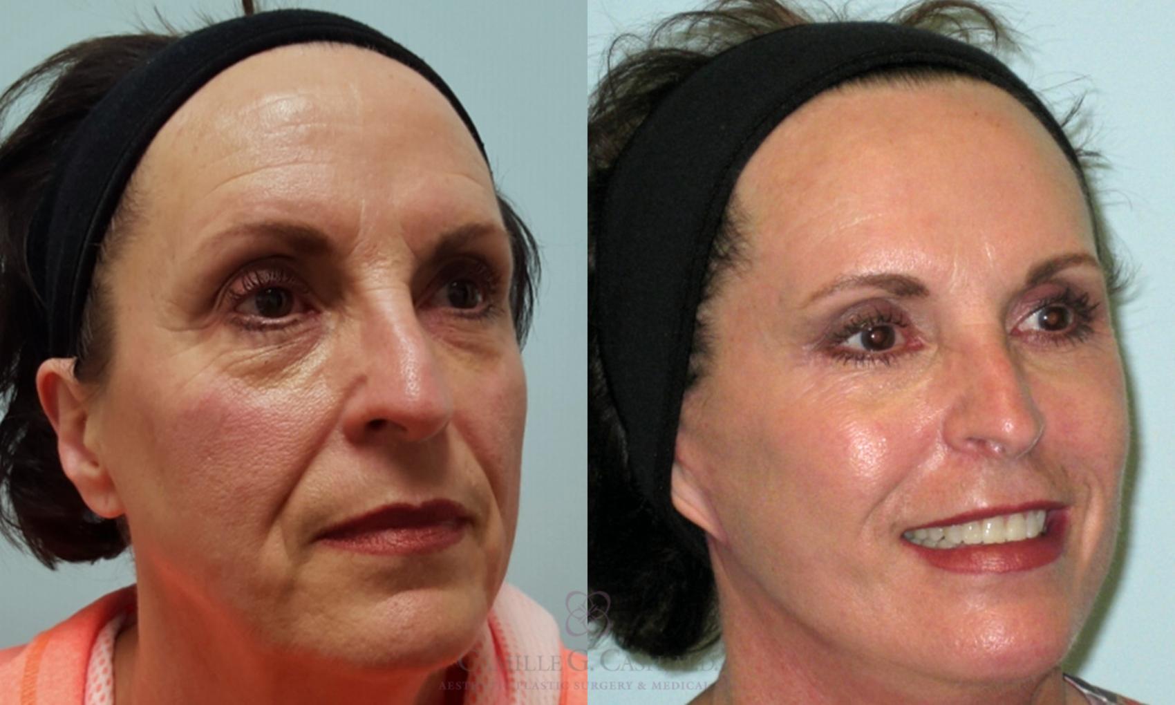 Before & After Facelift Case 163 View #2 View in Houston, TX