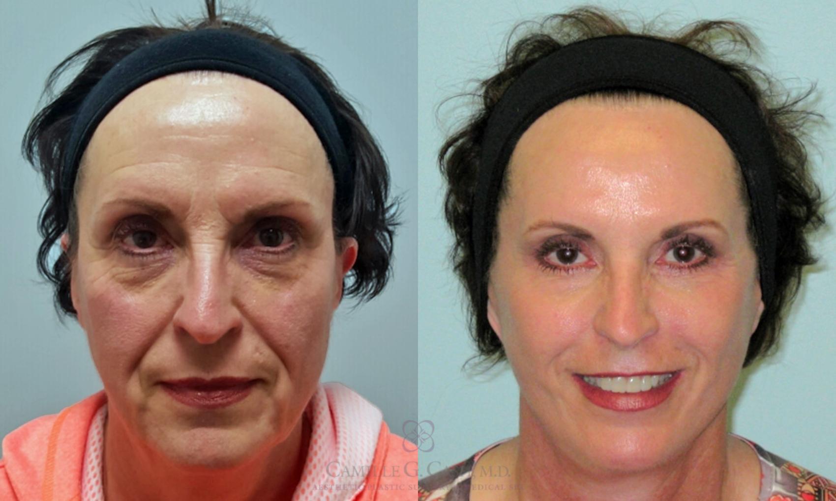 Before & After Facelift Case 163 View #3 View in Houston, TX