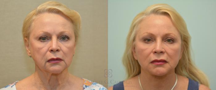 Before & After Facelift Case 227 View #1 View in Houston, TX