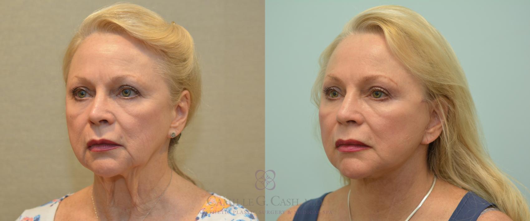Before & After Facelift Case 227 View #2 View in Houston, TX