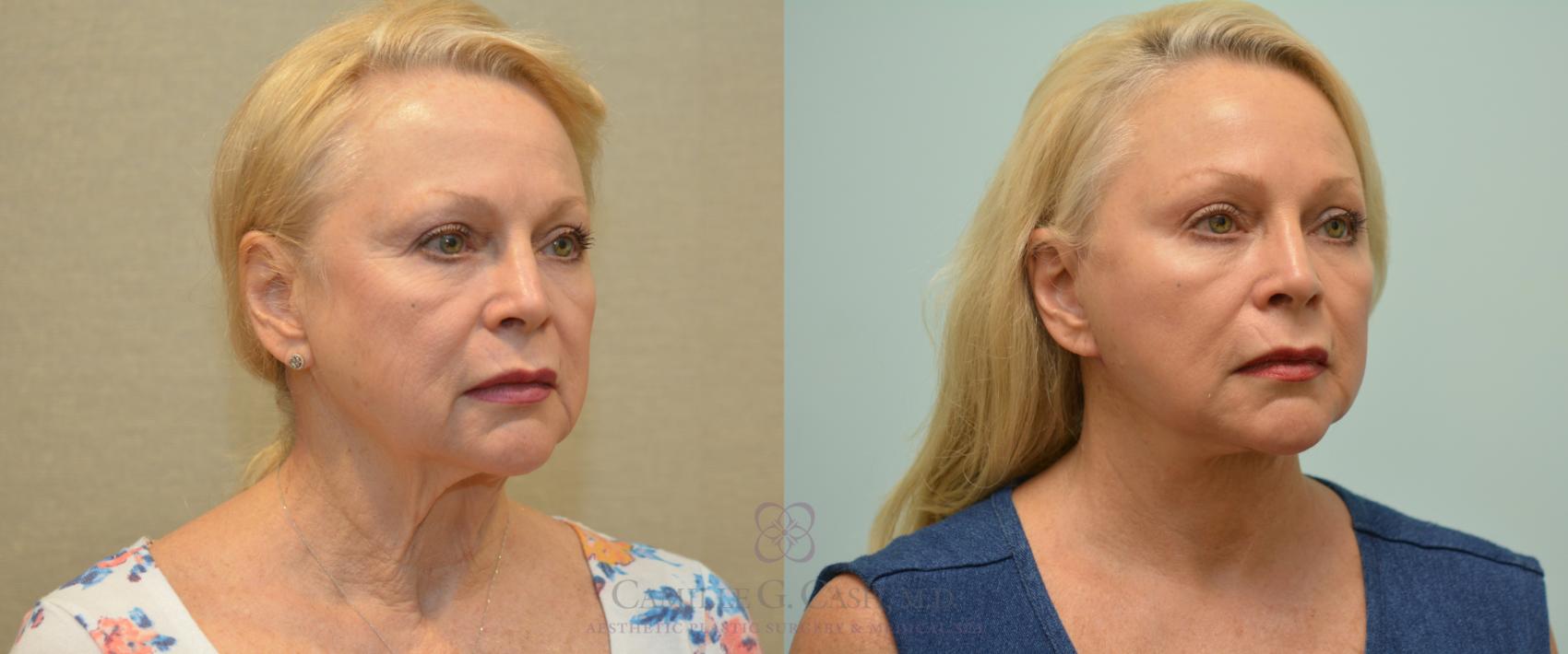 Before & After Facelift Case 227 View #3 View in Houston, TX