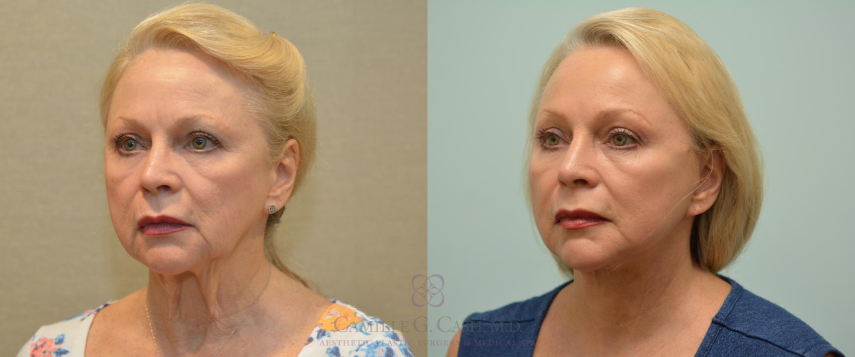 Before & After Facelift Case 227 View #4 View in Houston, TX