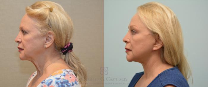 Before & After Facelift Case 227 View #5 View in Houston, TX