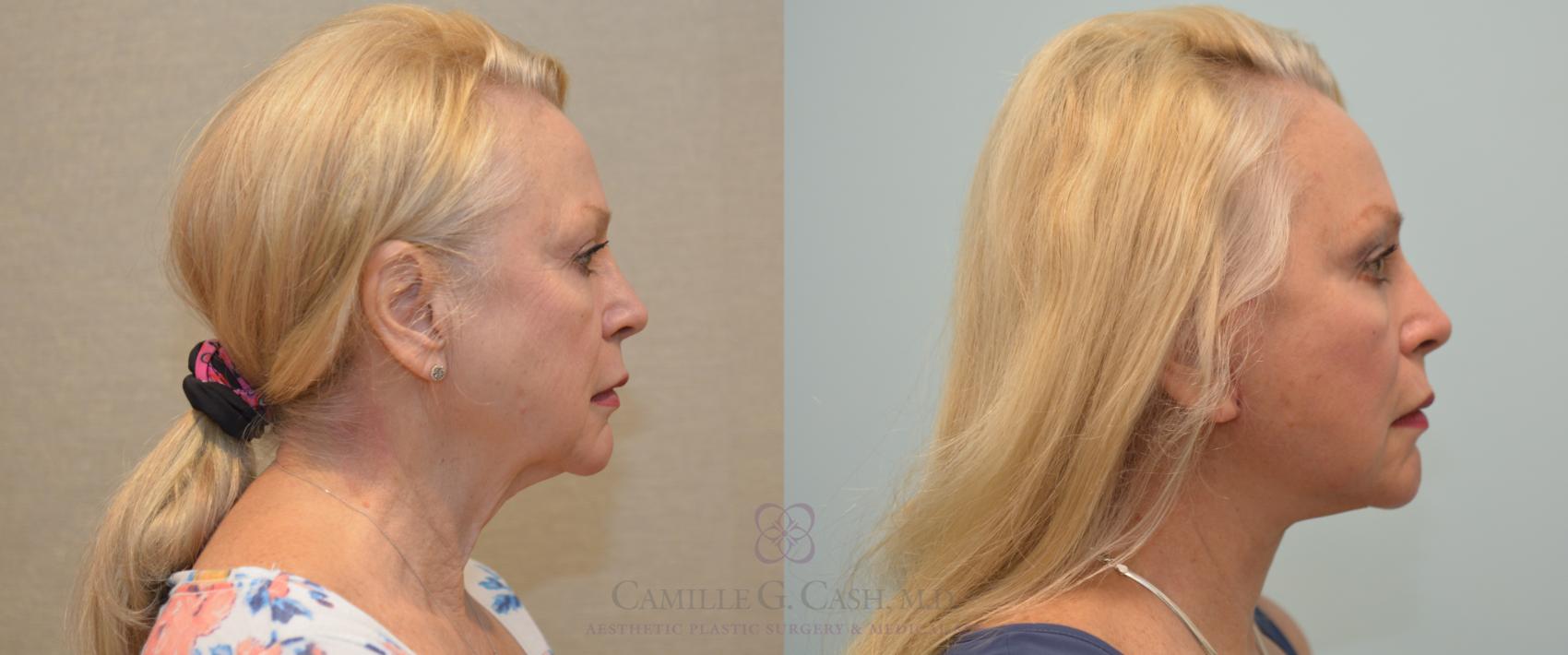 Before & After Facelift Case 227 View #6 View in Houston, TX