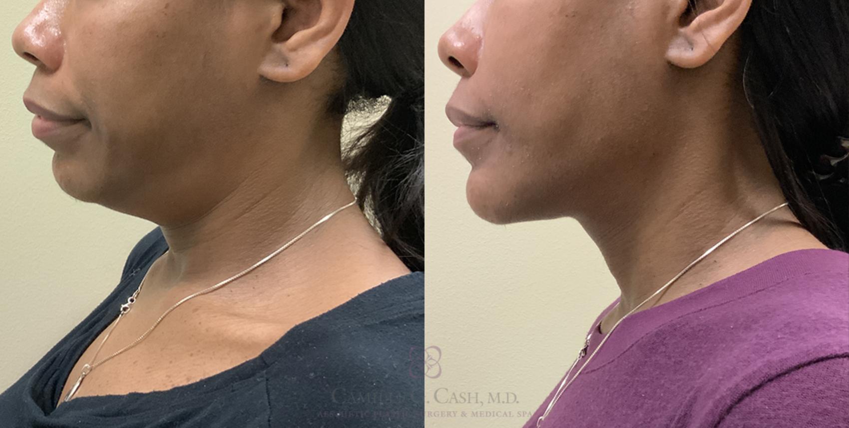 Before & After FaceTite Case 330 View #1 View in Houston, TX