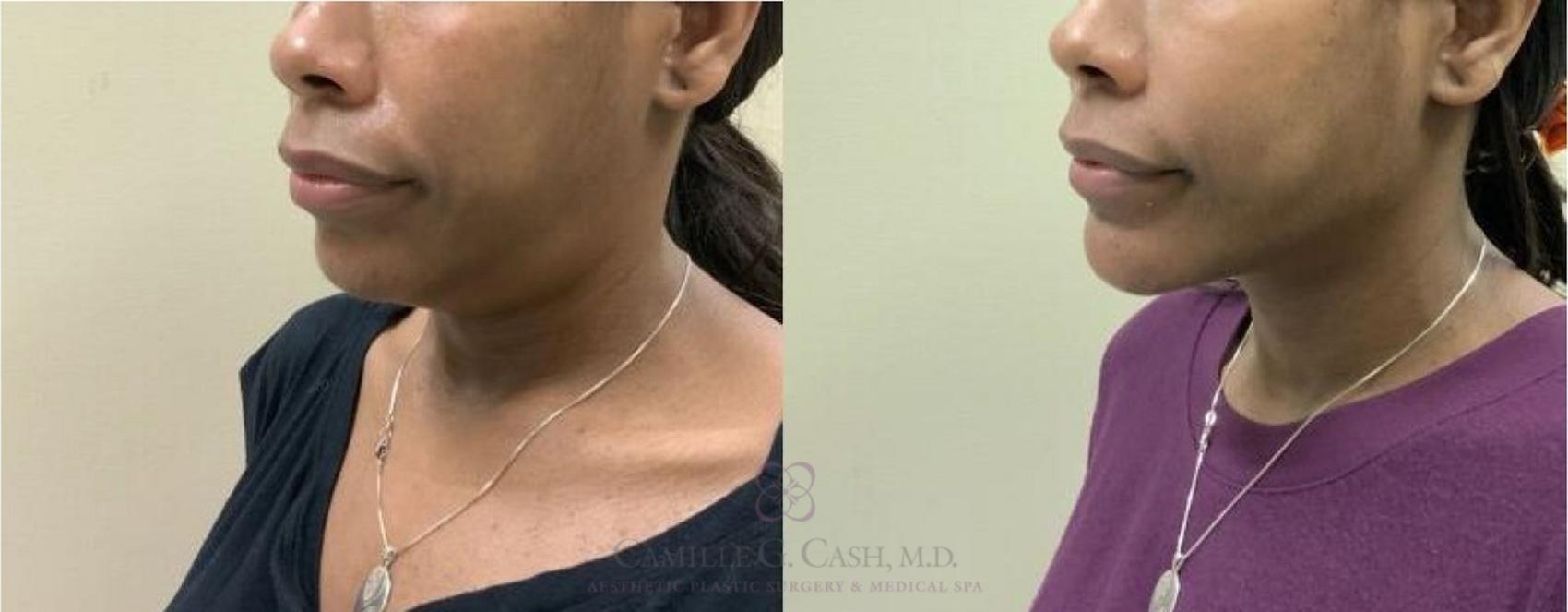 Before & After FaceTite Case 330 View #2 View in Houston, TX