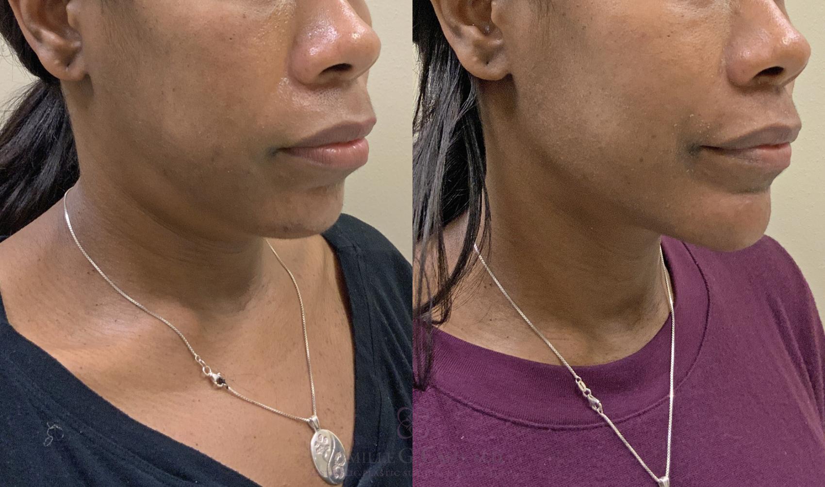 Before & After FaceTite Case 330 View #3 View in Houston, TX