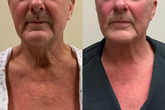 Before & After Male Facial Enhancement Case 337 Front View in Houston, TX