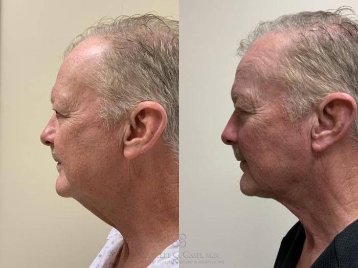 Before & After Male Facial Enhancement Case 337 Left Side View in Houston, TX