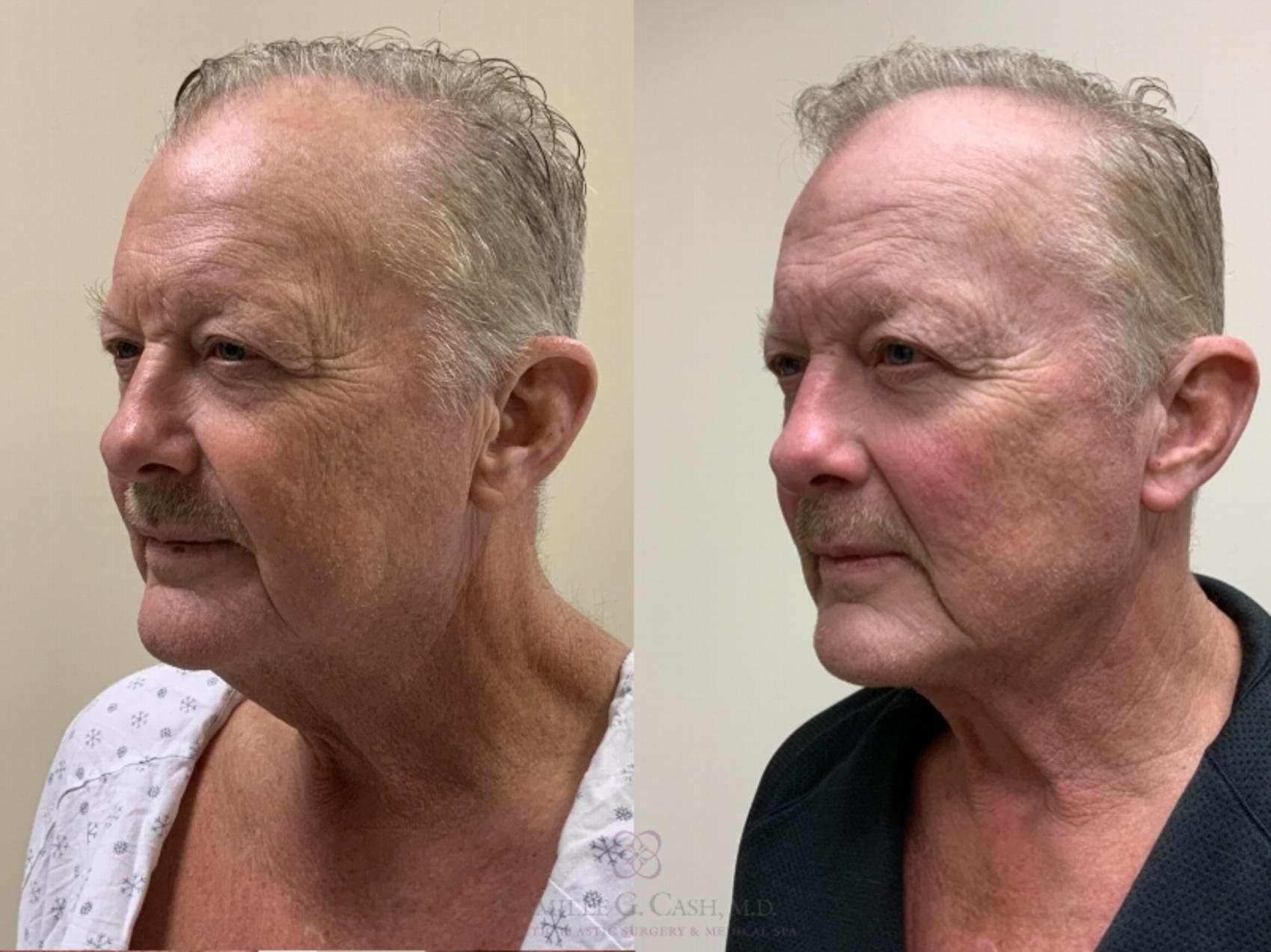 Before & After FaceTite Case 337 Right Oblique View in Houston, TX