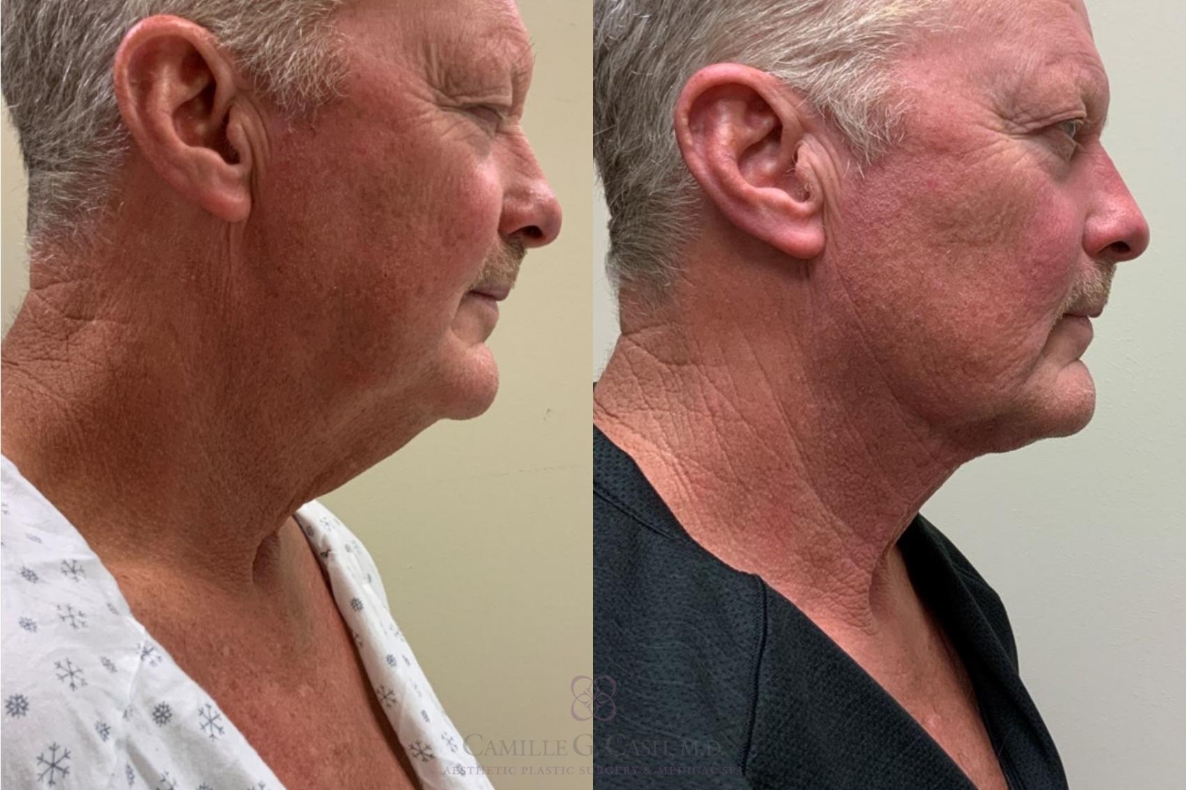 Before & After FaceTite Case 337 Right Side View in Houston, TX