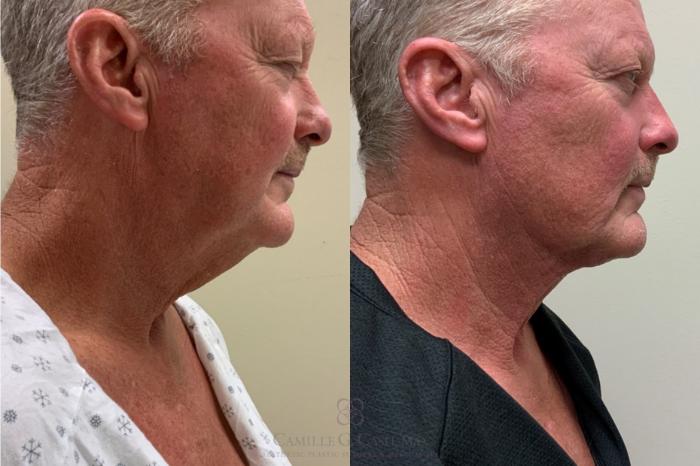 Before & After Male Facial Enhancement Case 337 Right Side View in Houston, TX