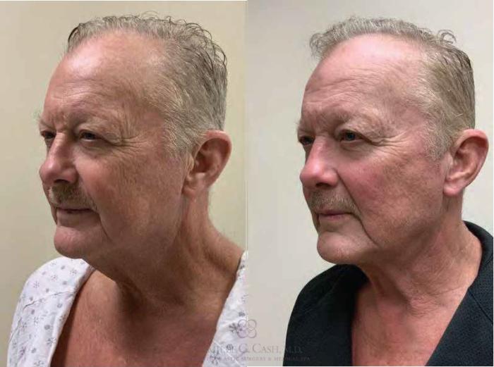 Before & After Male Facial Enhancement Case 337 View #2 View in Houston, TX