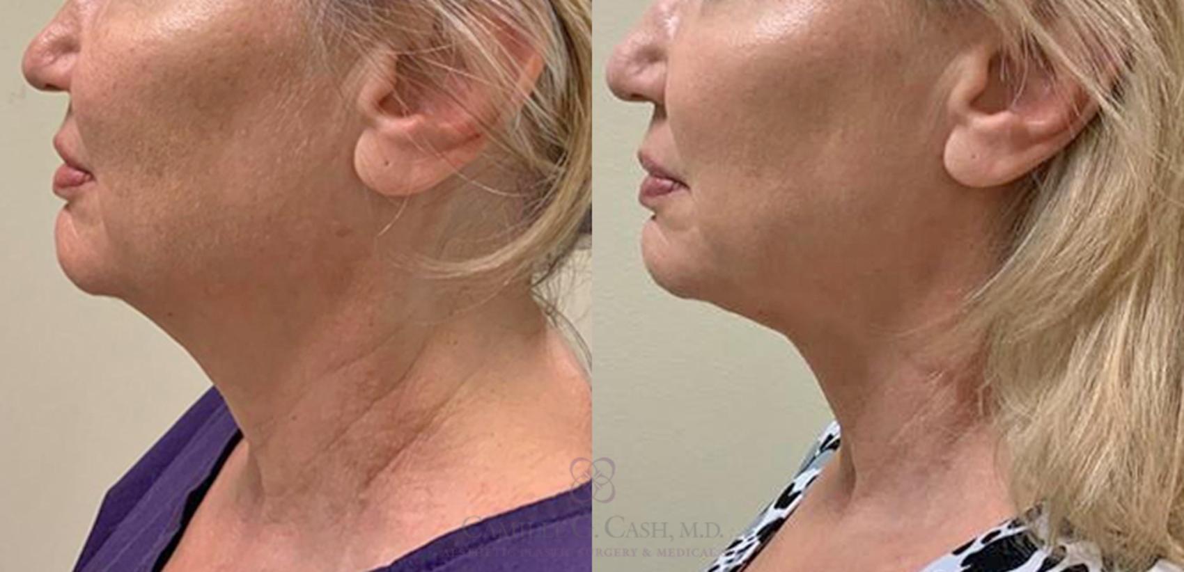 Before & After FaceTite Case 358 View #1 View in Houston, TX