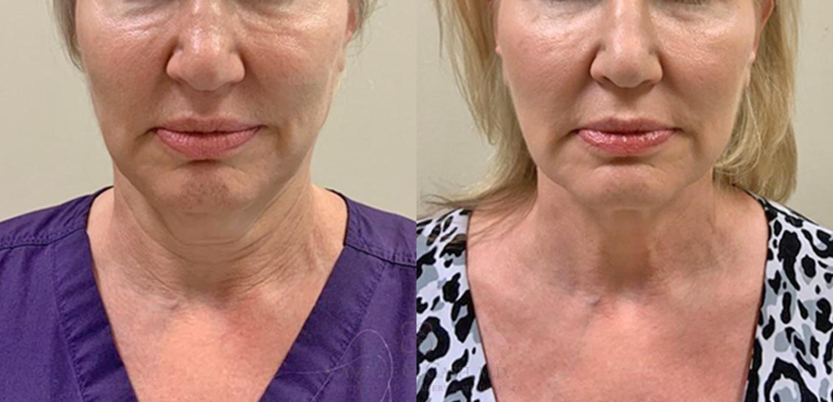 Before & After FaceTite Case 358 View #3 View in Houston, TX
