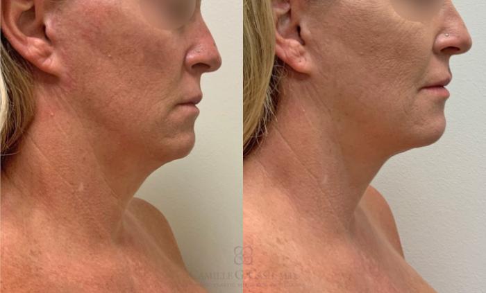 Before & After FaceTite Case 387 View #1 View in Houston, TX