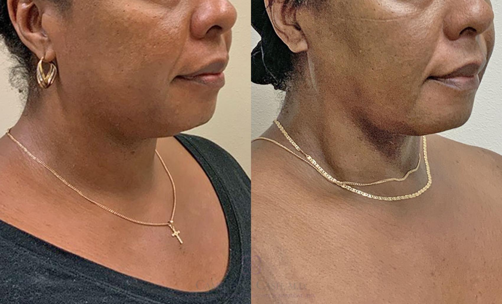 Before & After FaceTite Case 407 View #3 View in Houston, TX