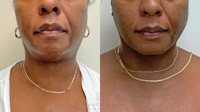 Before & After FaceTite Case 407 View #5 View in Houston, TX