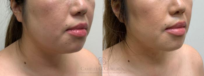 Before & After FaceTite Case 636 Right Oblique View in Houston, TX