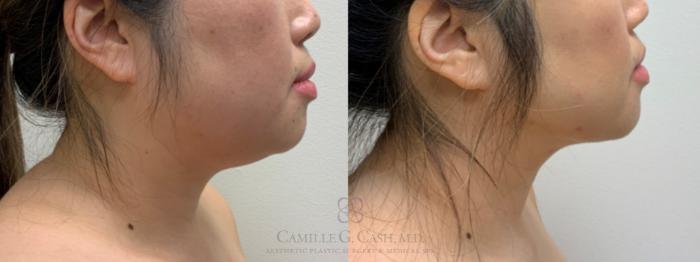 Before & After FaceTite Case 636 Right Side View in Houston, TX