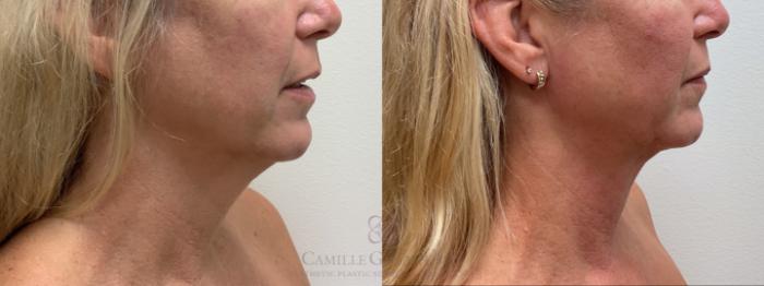 Before & After FaceTite Case 712 right side 24 months after View in Houston, TX