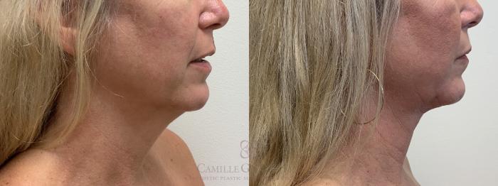 Before & After FaceTite Case 712 Right Side View in Houston, TX