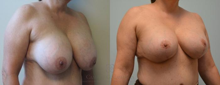 Before & After Implant Exchange and Revision Case 100 View #2 View in Houston, TX