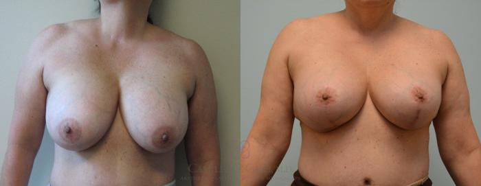 Before & After Implant Exchange and Revision Case 100 View #4 View in Houston, TX