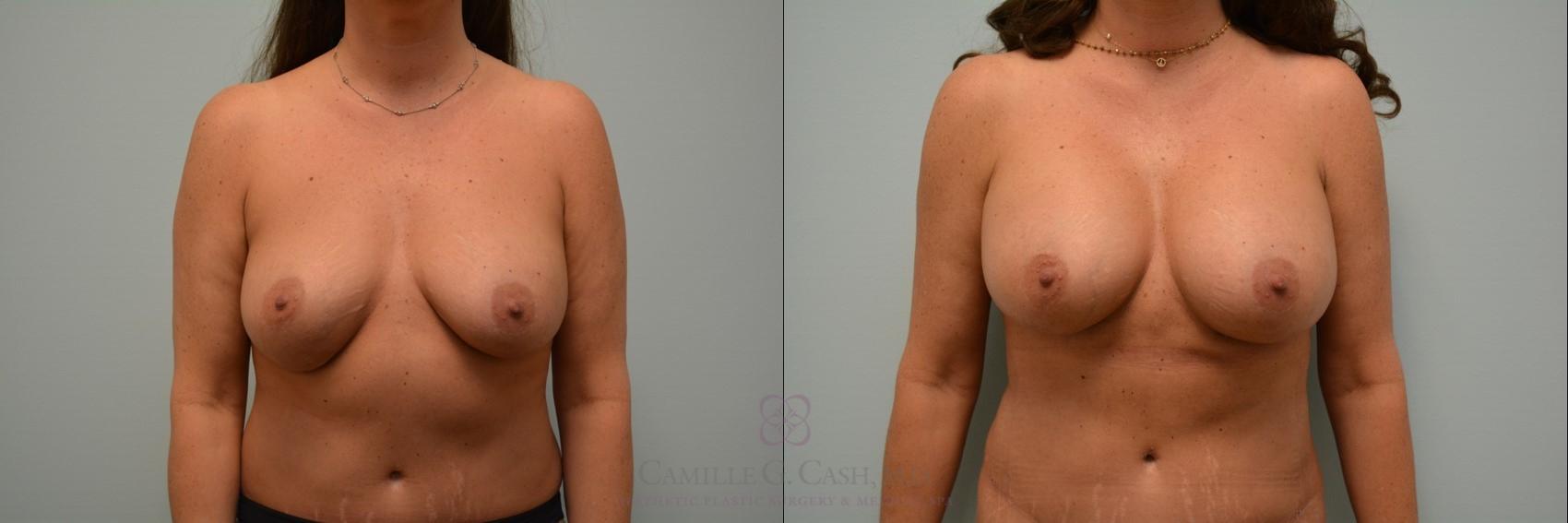 Before & After Implant Exchange and Revision Case 159 View #1 View in Houston, TX