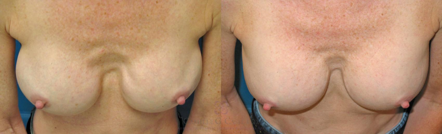 Before & After Implant Exchange and Revision Case 178 View #2 View in Houston, TX