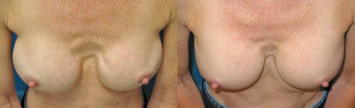 Before & After Implant Exchange and Revision Case 178 View #2 View in Houston, TX