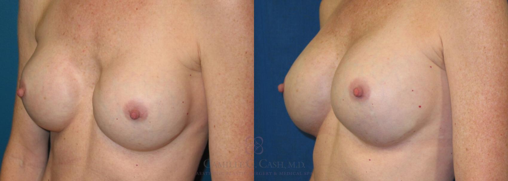 Before & After Implant Exchange and Revision Case 178 View #3 View in Houston, TX