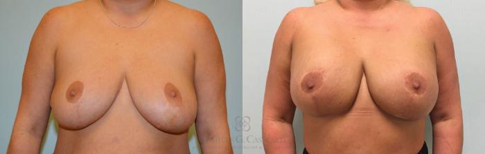 Before & After Implant Exchange and Revision Case 294 View #1 View in Houston, TX