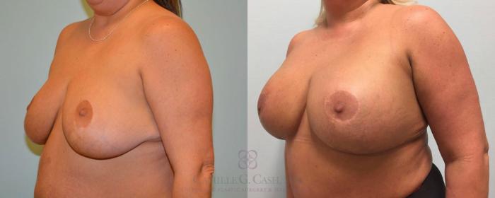 Before & After Implant Exchange and Revision Case 294 View #2 View in Houston, TX