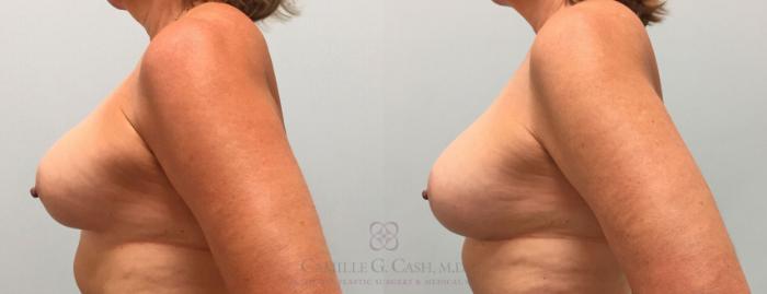 Before & After Implant Exchange and Revision Case 295 View #1 View in Houston, TX