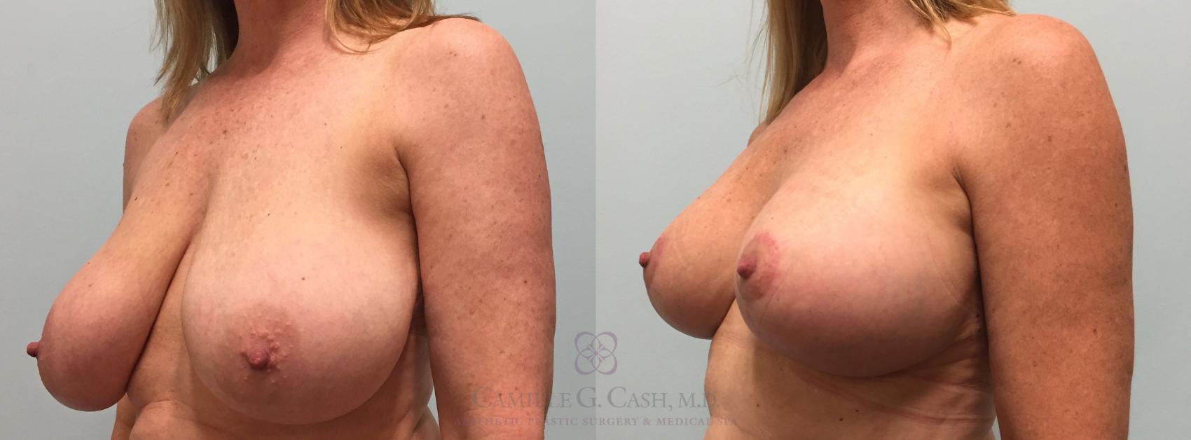 Before & After Implant Exchange and Revision Case 402 View #2 View in Houston, TX