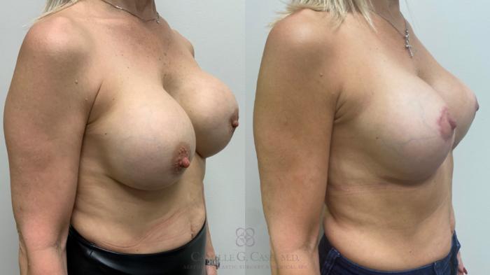 Before & After Implant Exchange and Revision Case 569 Left Oblique View in Houston, TX