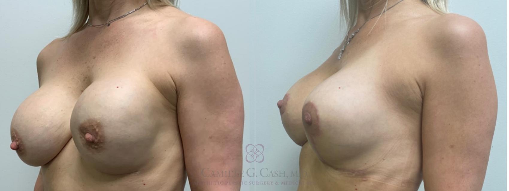 Before & After Implant Exchange and Revision Case 569 Right Oblique View in Houston, TX