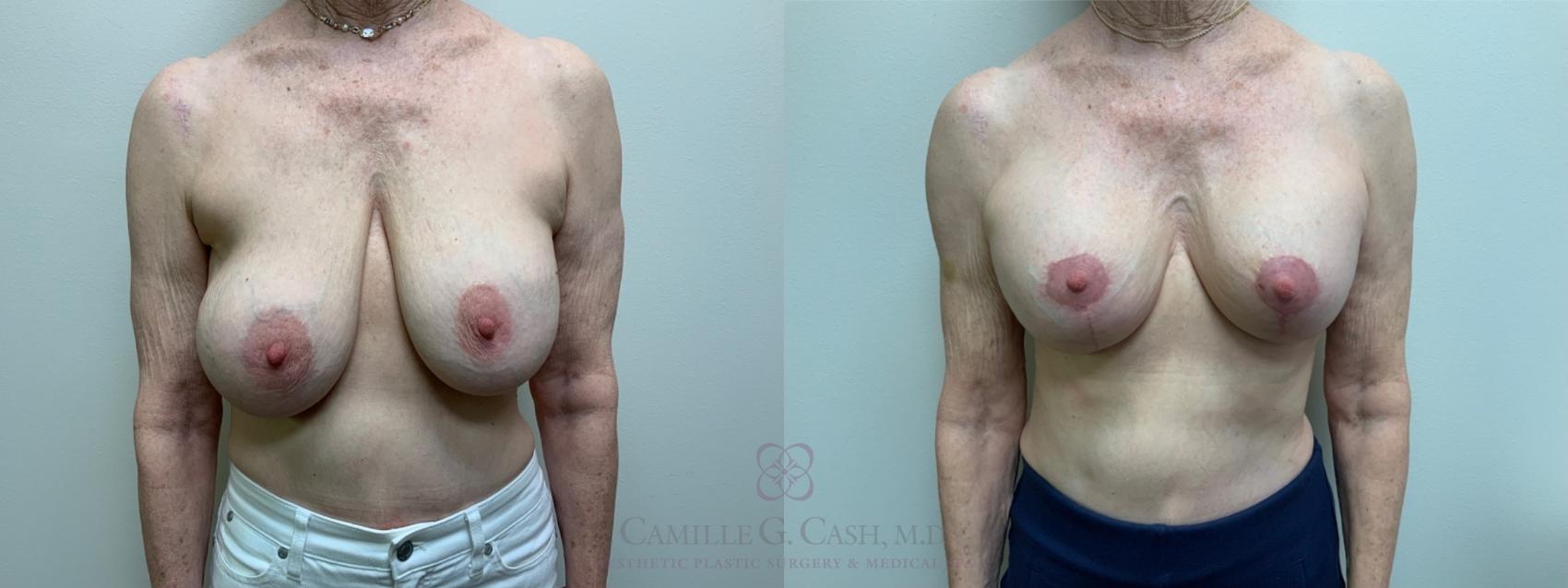 Before & After Implant Exchange and Revision Case 591 Front View in Houston, TX