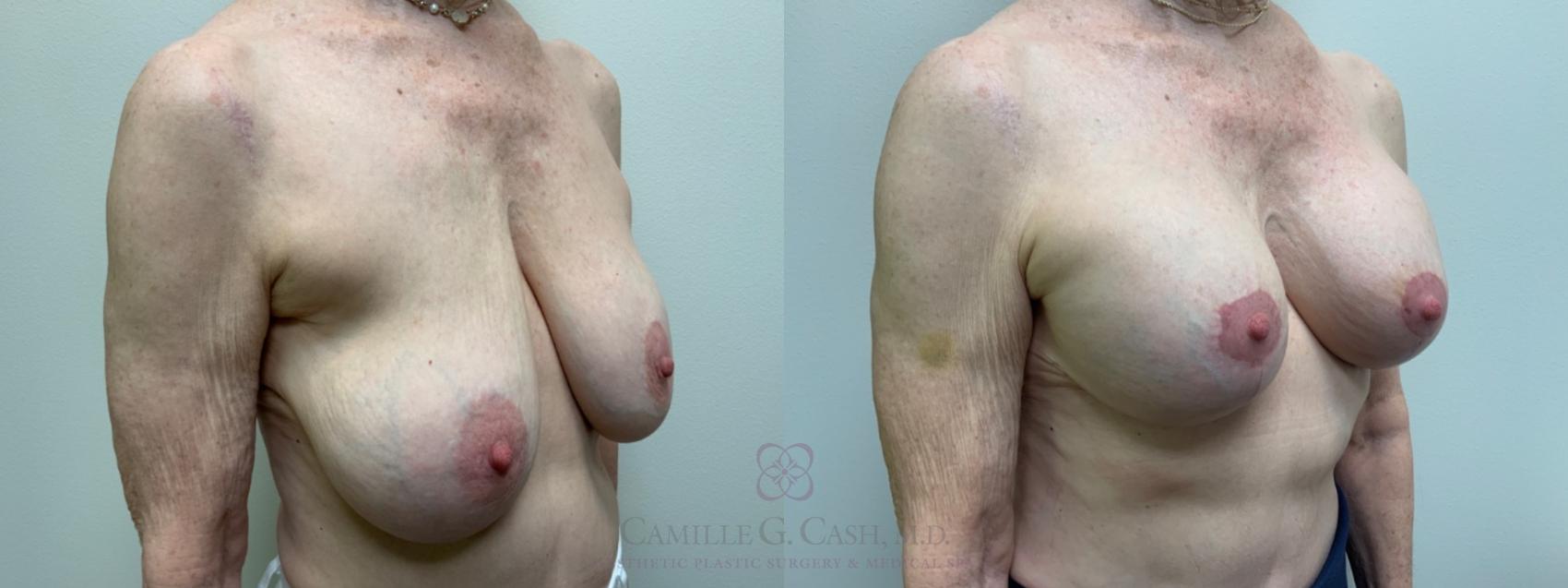 Before & After Implant Exchange and Revision Case 591 Left Oblique View in Houston, TX