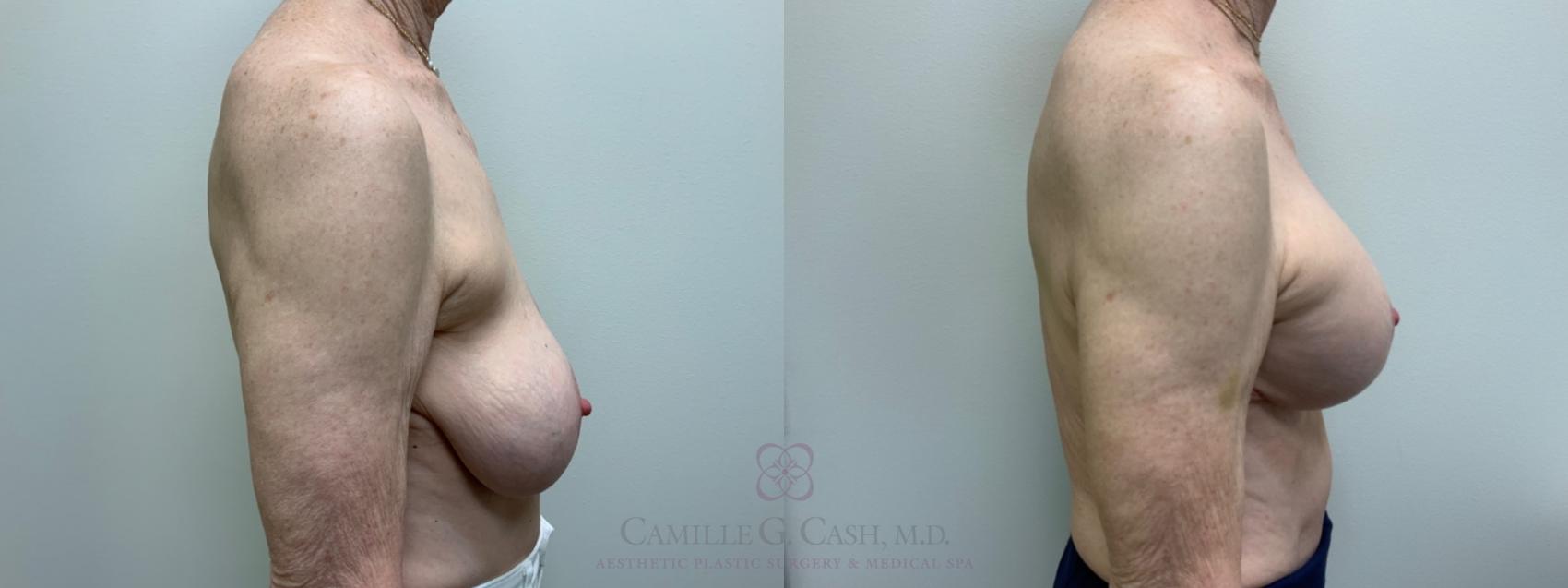 Before & After Implant Exchange and Revision Case 591 Left Side View in Houston, TX