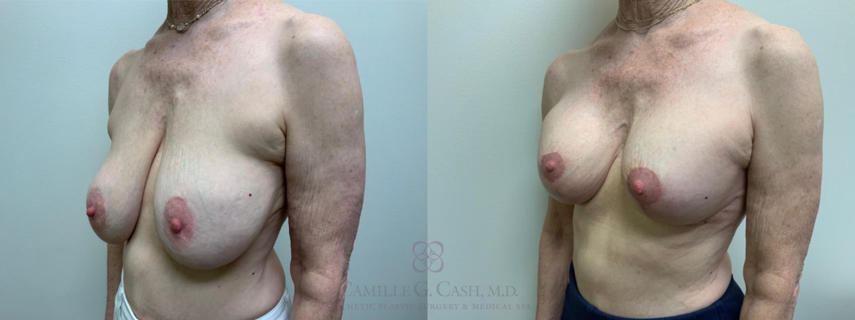 Before & After Implant Exchange and Revision Case 591 Right Oblique View in Houston, TX