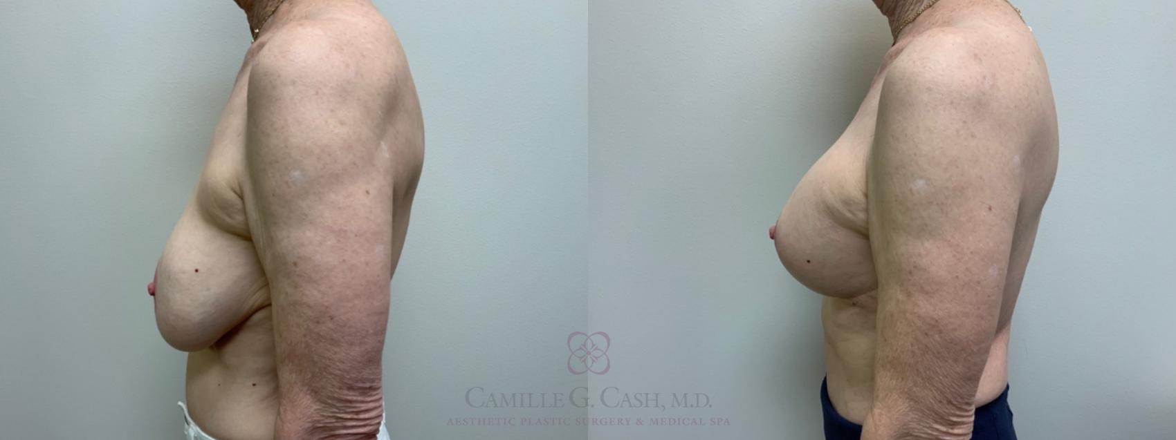 Before & After Implant Exchange and Revision Case 591 Right Side View in Houston, TX