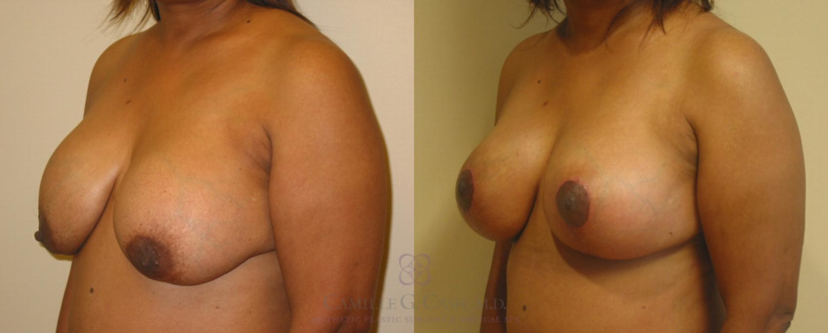 Before & After Implant Exchange and Revision Case 73 View #4 View in Houston, TX