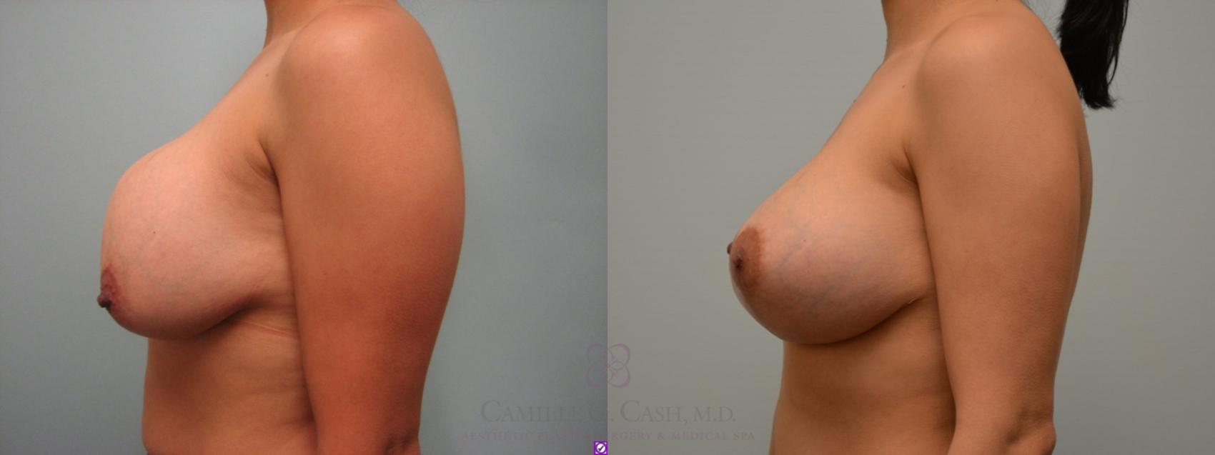 Before & After Implant Exchange and Revision Case 74 View #1 View in Houston, TX