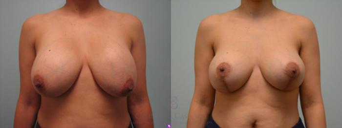 Before & After Implant Exchange and Revision Case 74 View #2 View in Houston, TX