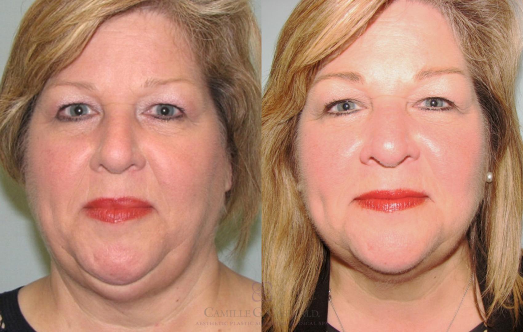 Before & After KYBELLA® Case 147 View #1 View in Houston, TX