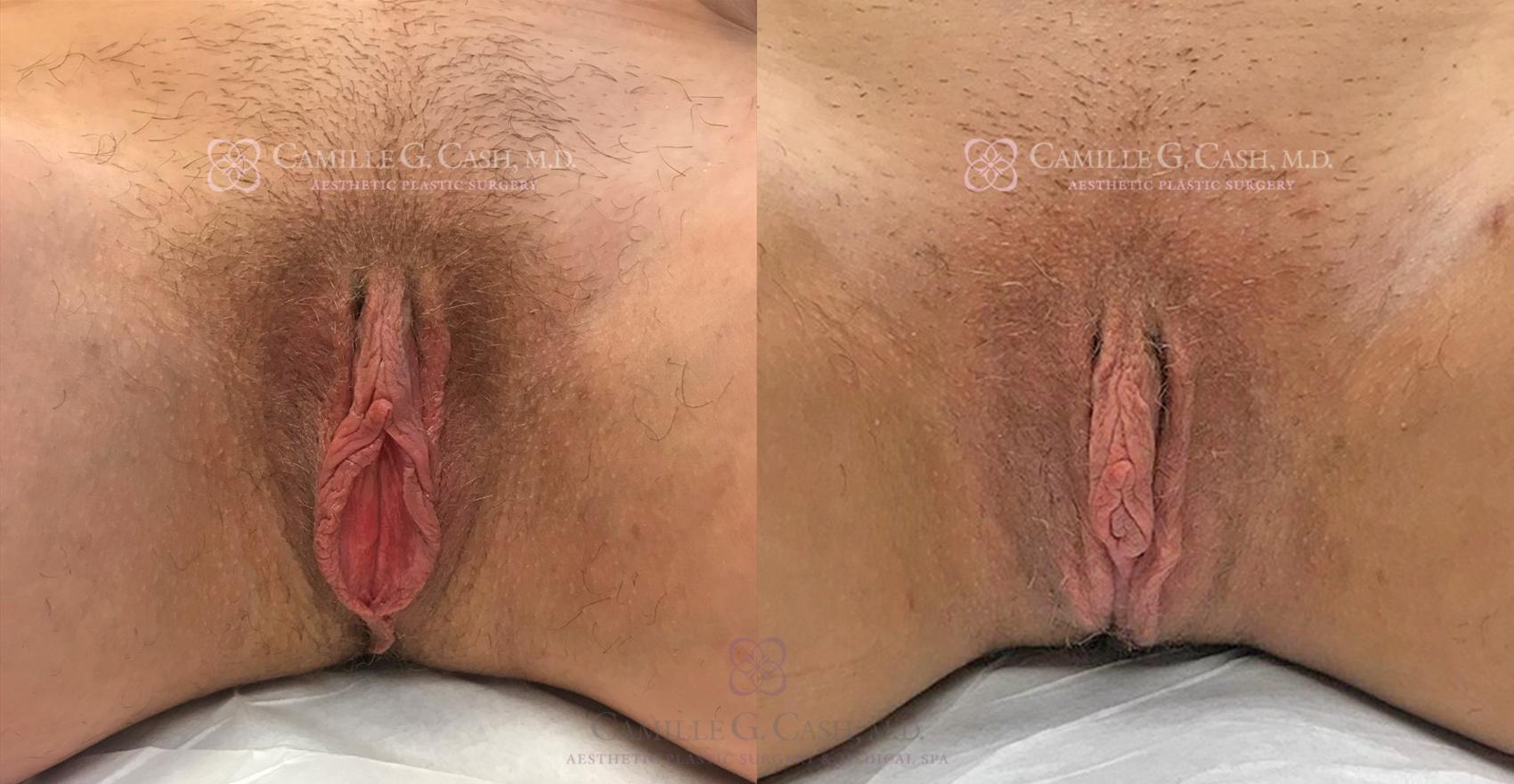 Before & After Labiaplasty Case 339 View #1 View in Houston, TX