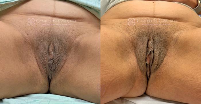 Before & After Labiaplasty Case 340 View #1 View in Houston, TX